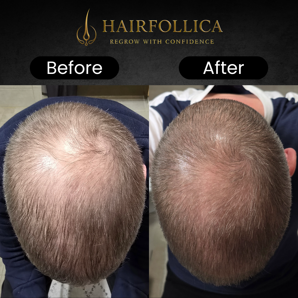 Hairfollica Foam 2.0