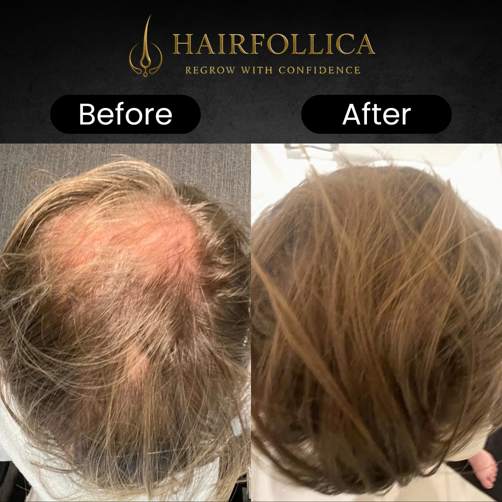 Hairfollica Foam 2.0
