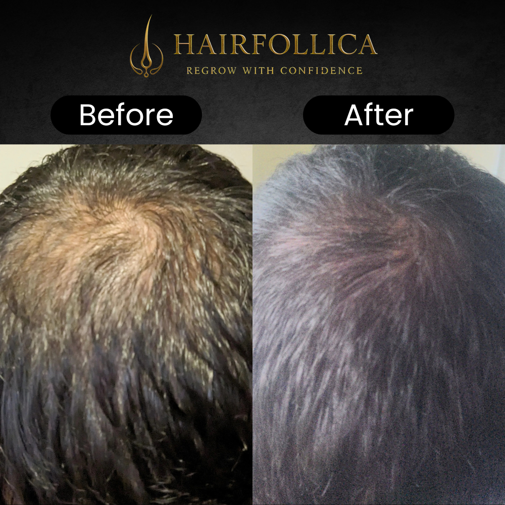 Hairfollica Foam 2.0