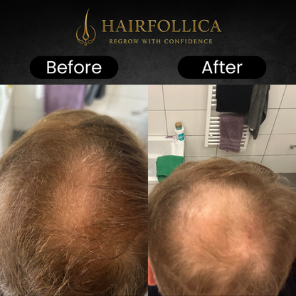 Hairfollica Foam 2.0